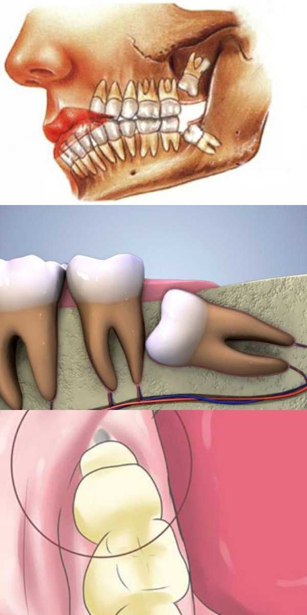 Что делать, если не вылез ни один зуб мудрости? - стоматология «королевство улыбок»