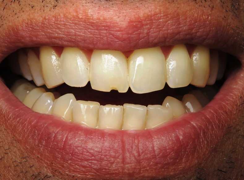 Что означает сломанный зуб у взрослого и ребенка – народные приметы, значение, возможные объяснения