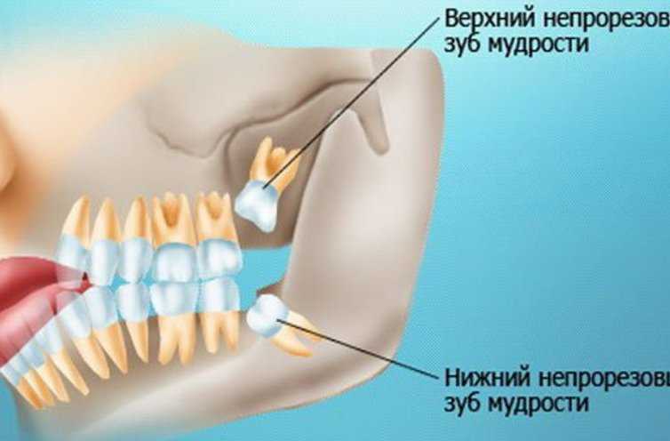 Зубы мудрости: симптомы прорезывания и роста, во сколько лет и как появляются, признаки