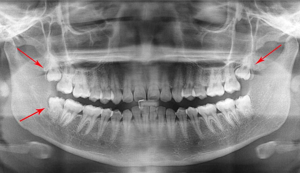 Как понять, что растет зуб мудрости: симптомы и первые признаки
