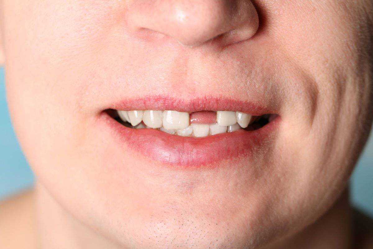 К чему снится вырванный зуб, рвать зуб себе самому или другому? основные толкования, к чему снится вырывать зубы самому себе