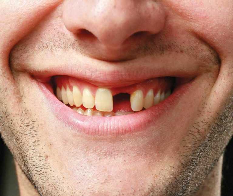 К чему снится выпадение зубов: толкование сновидения по различным сонникам
